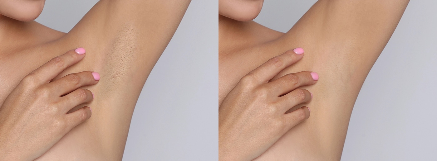 Unwanted Hair Before and After