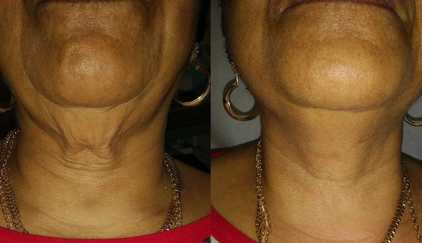 Forma Before and After Treatment