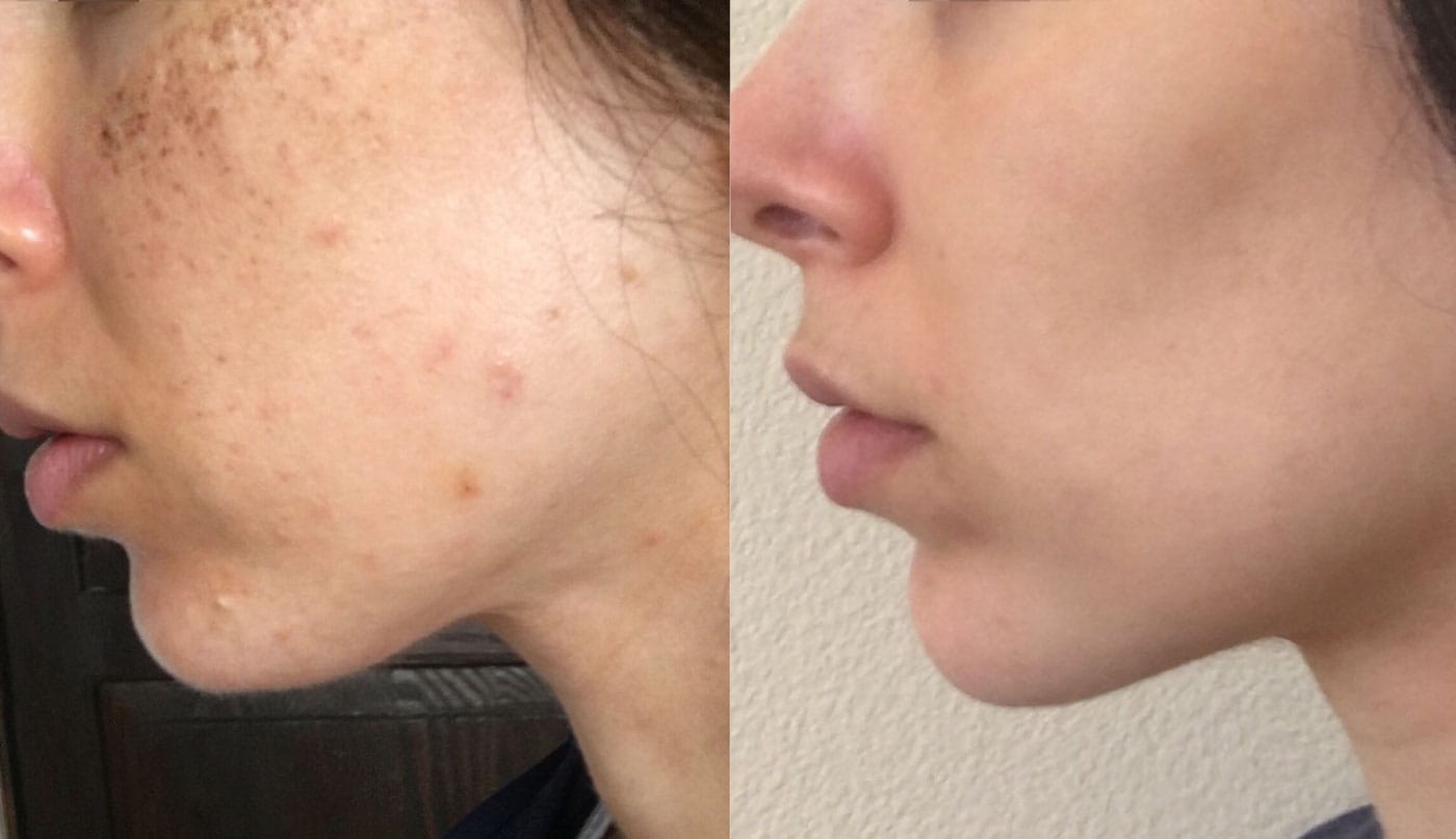 IPL Before and After Treatment